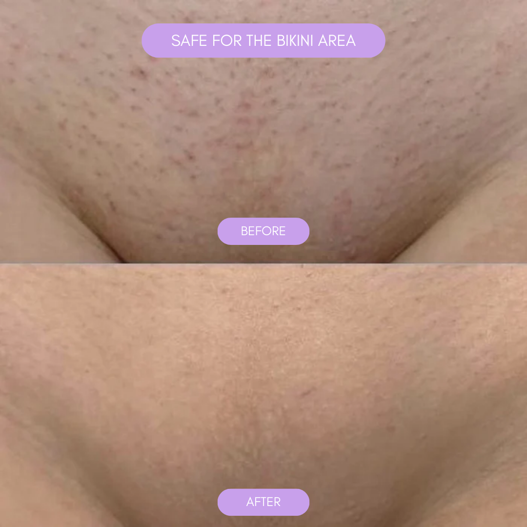 Hårborttagningsapparat för mjuk len hud Carvallo