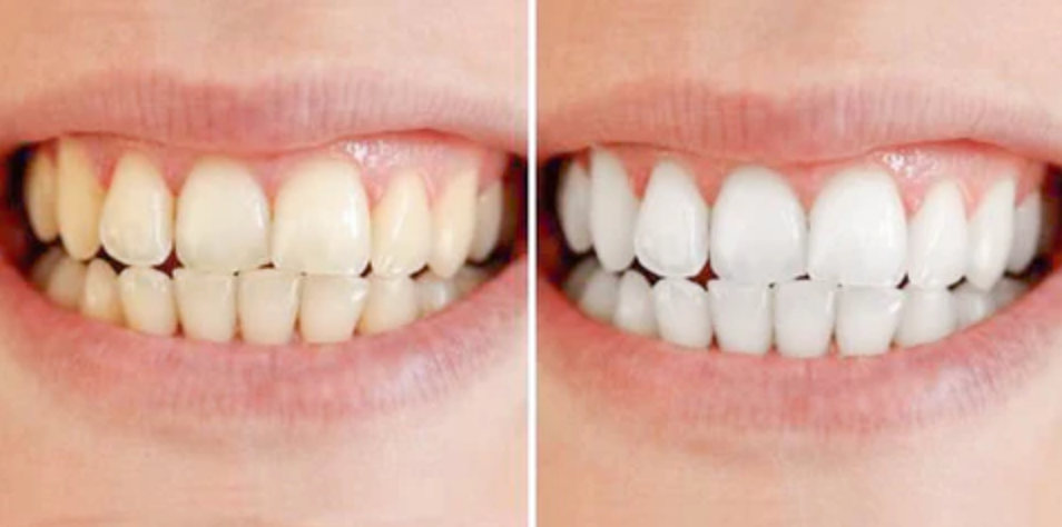 Tandblekningspenna – Kliniskt inspirerad blekning hemma-VaruZ-Hemnix