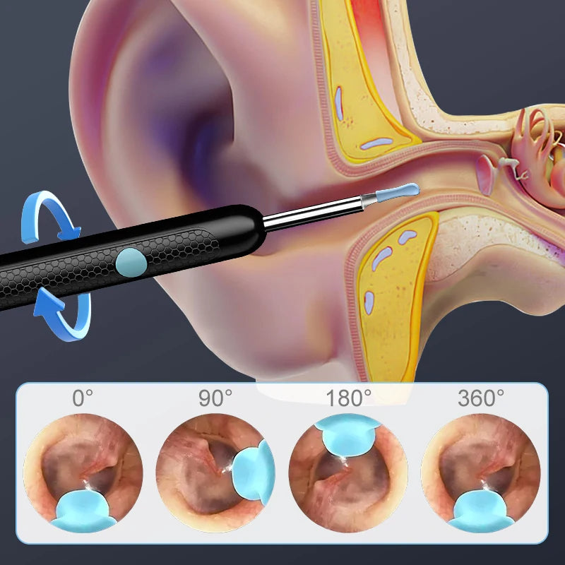 Öronvaxborttagning Carvallo