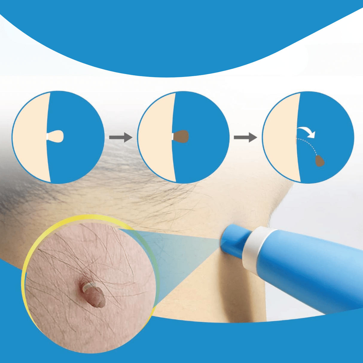 Carvallo – Naturlig vårtorpsavlägsnare Carvallo