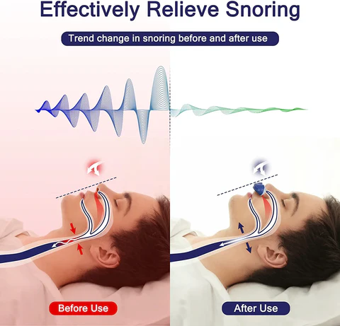 Anti Snoring Nose Clip för Bättre Sömn Carvallo