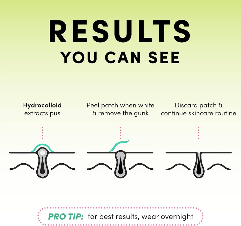 PoreClean - Akneplåster med Hydrokolloid för Frisk Hud på En Natt-Akne Plåster-HealyNova-Hemnix