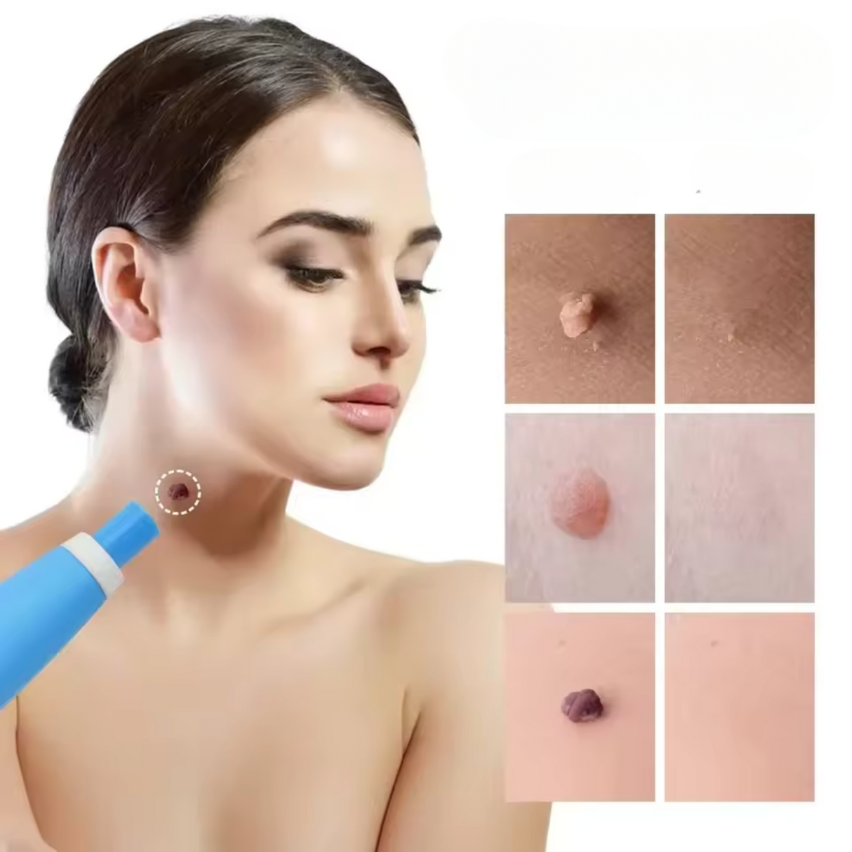 Carvallo – Naturlig vårtorpsavlägsnare Carvallo