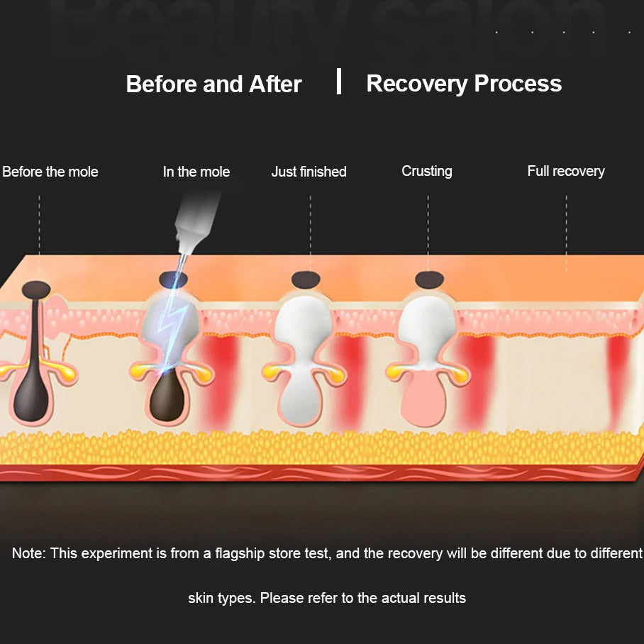 Plasmapenna Hudfliks Borttagare-Personligt-BB-Hemnix