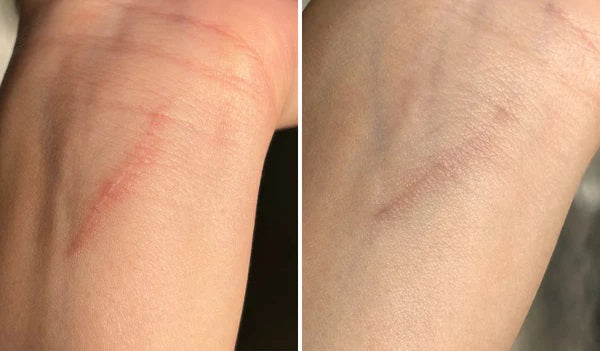 Luviva - Avancerad Silikontejp för Ärrbehandling & Rynkor-Skönhet Ansiktsmask-LUVIVA-Hemnix