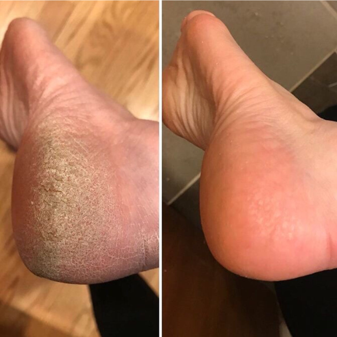 Elektrisk Fotfil - få lena och fina fötter-Hemnix-Hemnix