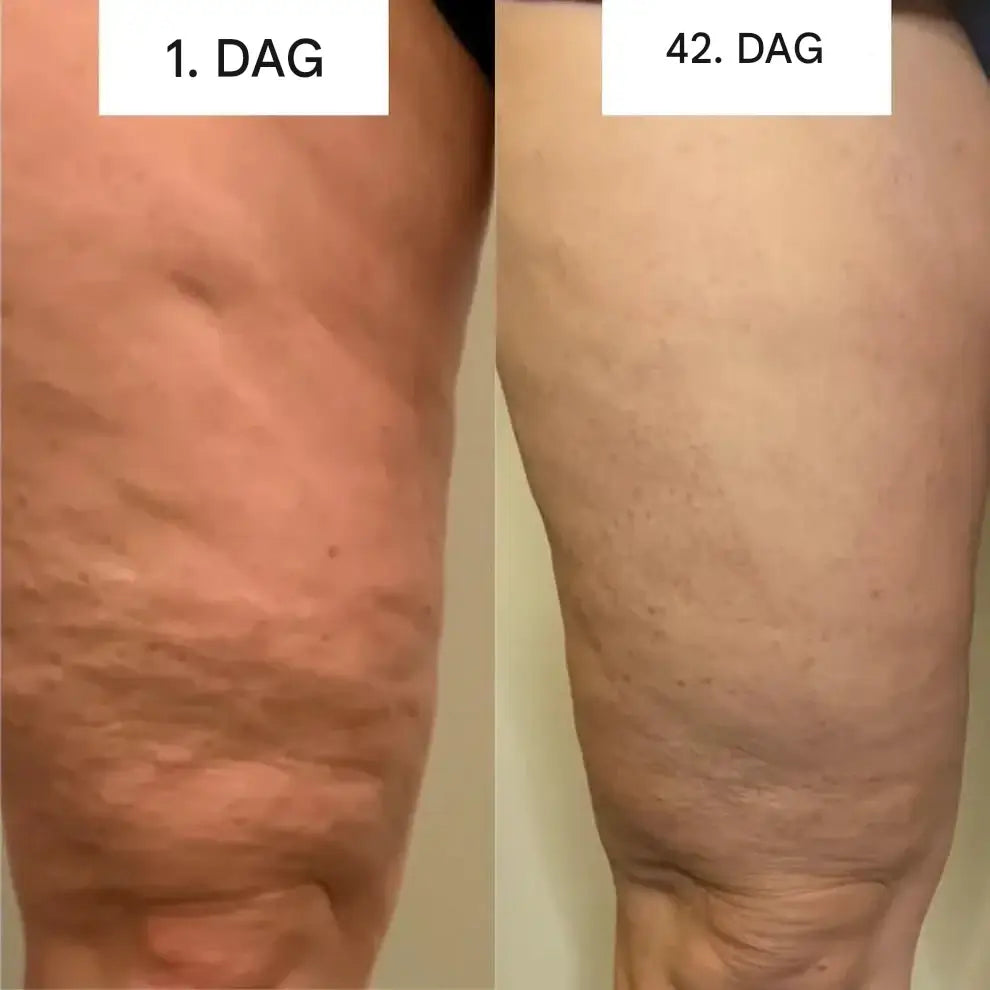 GlowCup – Cellulite Remover och Hudåtstramning med Rödljus och Koppningsterapi-Electric Massagers-BB-Hemnix