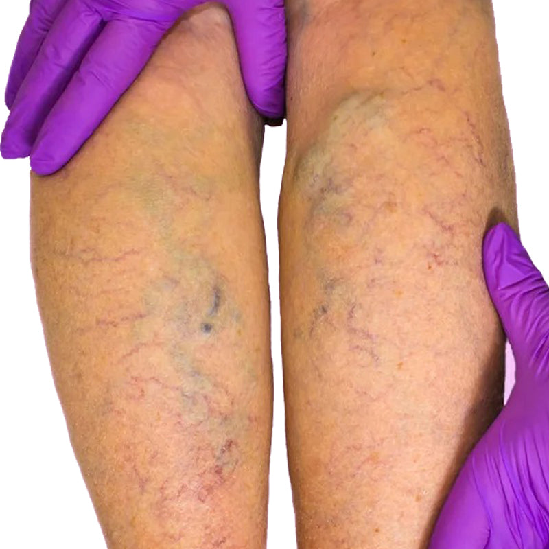 Plåster för Åderbråck & Svullna Ben-Hemnix-Hemnix