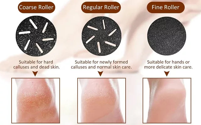 Royaleva Vacuum Callus Remover med uppladdningsbart batteri Carvallo