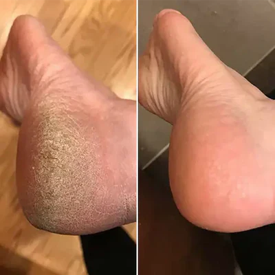 Bliss Silk Pro 2 – Mjuka fötter utan dyra salongsbesök-VaruZ-Hemnix