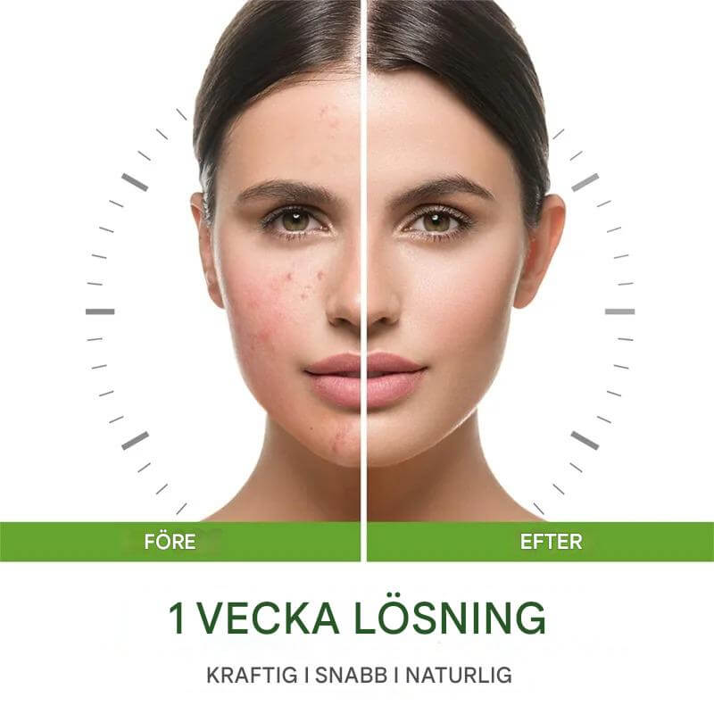 GrönRoa – Vegansk Ansiktskräm med Tea Tree | För en Lugnare, Mer Balanserad Hud-Acne Treatments & Kits-BB-Hemnix