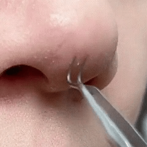 Luxora Svartprick Tång - Anti Svartprick Kit Set 3 Pcs Carvallo