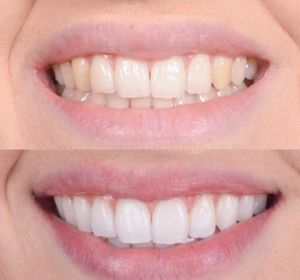 Tandblekningspenna – Kliniskt inspirerad blekning hemma-VaruZ-Hemnix