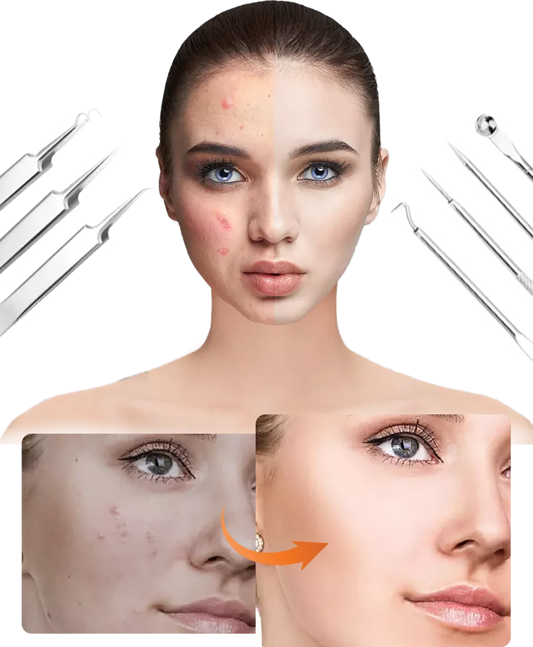 Carvallo Set PureSkinX | Precise & Hygienic | Stainless Steel Tools for Clear Skin Carvallo