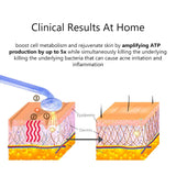 Professionell Högfrekvens Ansikts- & Hårterapi Penna Carvallo