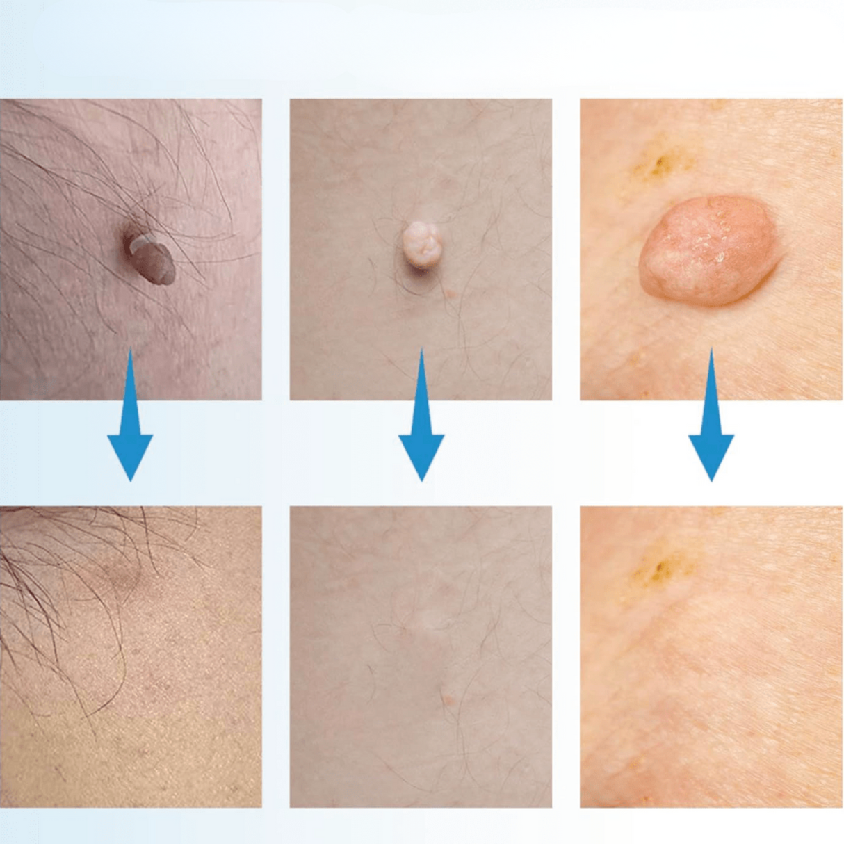 Carvallo – Naturlig vårtorpsavlägsnare Carvallo