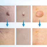 Carvallo – Naturlig vårtorpsavlägsnare Carvallo