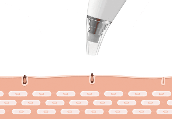 Blackhead Borttagare Vacuum Pore Rengöringsverktyg Carvallo
