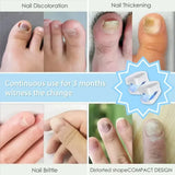 Nagelsvamp Rengöringslaser Enhet - Expert Revolutionerande Hög-Effektiv Ljusterapi Enhet För Tåspik Sjukdomar Carvallo