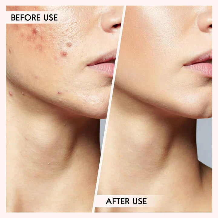 Pormask- och finnarborttagningsset Carvallo