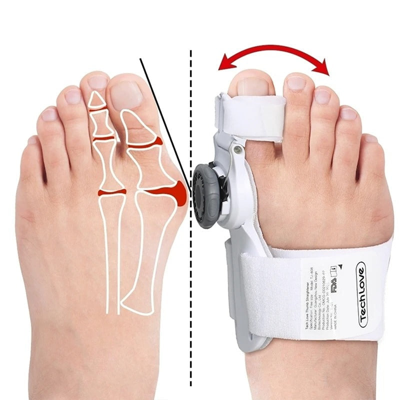 Uppgraderad Tå Bunion Korrigerare – Justerbar Ortopedisk Splint för Smärtlindring & Alignment Carvallo