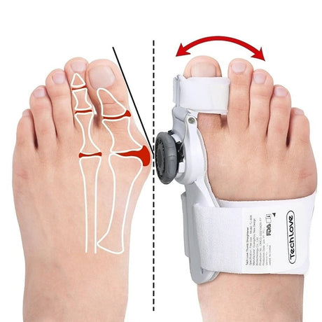 Uppgraderad Tå Bunion Korrigerare – Justerbar Ortopedisk Splint för Smärtlindring & Alignment Carvallo