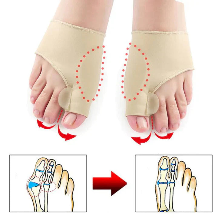 Ortopedisk tåkorrigerare (1 par) - Hallux Valgus-stöd och smärtlindringshölje MILA Sverige