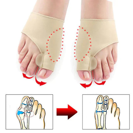 Ortopedisk tåkorrigerare (1 par) - Hallux Valgus-stöd och smärtlindringshölje MILA Sverige