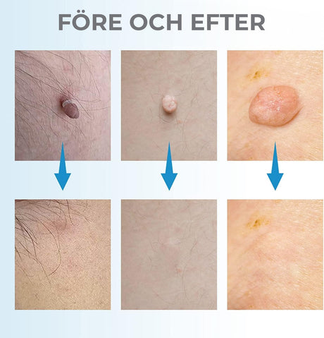 Leverfläcksborttagning - borttagning av födelsemärke-Hemnix-Hemnix