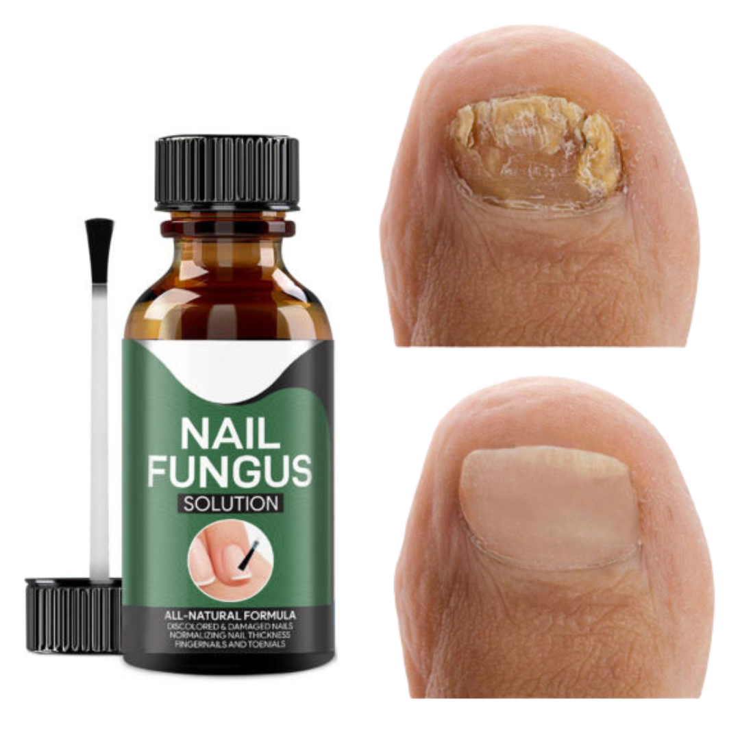 Avancerat svampdödande nagelserum – Snabb lindring av tånagel- och fingernagelinfektioner MILA Sverige