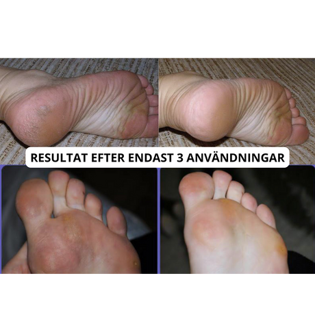 Elektrisk Fotfil Pro-VaruZ-Hemnix