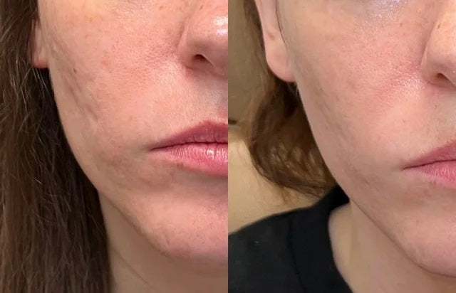 Luviva - Avancerad Silikontejp för Ärrbehandling & Rynkor-Skönhet Ansiktsmask-LUVIVA-Hemnix