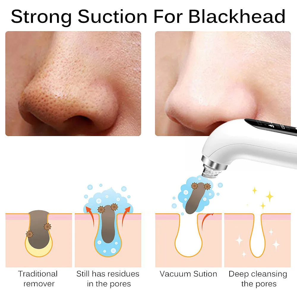 Uppdaterad Blackhead Remover Pore Vacuum Carvallo