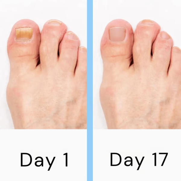 Lasernagelterapiapparat – Avancerad svampdödande behandling för tånaglar och fingernaglar MILA Sverige