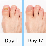 Lasernagelterapiapparat – Avancerad svampdödande behandling för tånaglar och fingernaglar MILA Sverige