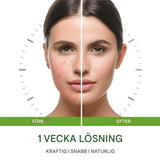 GrönRoa – Vegansk Ansiktskräm med Tea Tree | För en Lugnare, Mer Balanserad Hud-Acne Treatments & Kits-BB-Hemnix